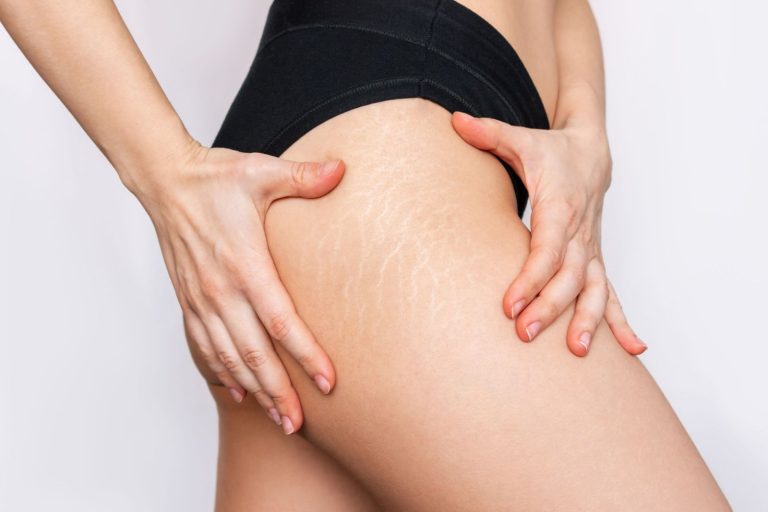 Pérdida de colágeno