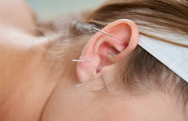 Qué es la auriculoterapia