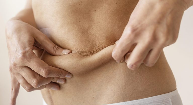 Piel irregular y celulitis