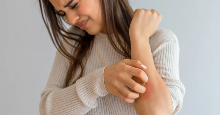 Alergia por estrés